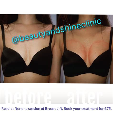Non Surgical Breast Lift Before And After