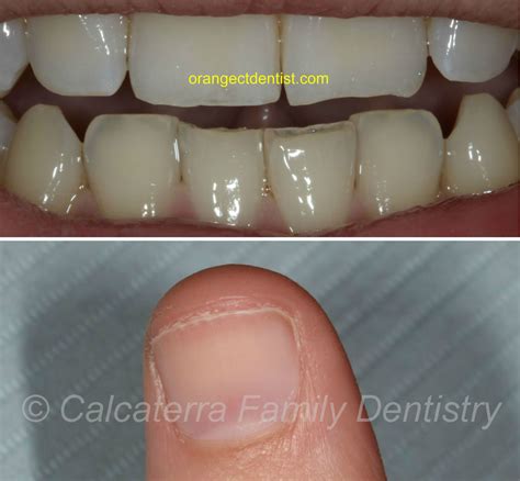 Is Chewing Your Nails Bad For Your Teeth at Tommy Bautista blog