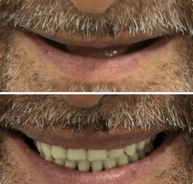 Full Mouth Dental Implants Surgery and Cost in India - Dezy