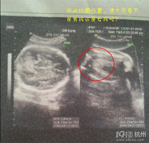 怀孕27周胎儿彩超图_百度宝宝知道-我们这里没有四维彩超 请问普通彩超能检查出胎儿畸形吗