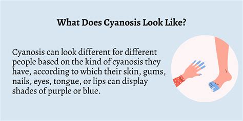 Peripheral Cyanosis In Newborn Cyanosis Wikipedia
