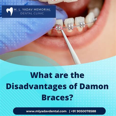 Problems With Damon Braces What Are Self Ligating Braces? | Masri
