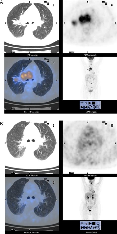 PET/CT imaging in different types of lung cancer: An overview ...