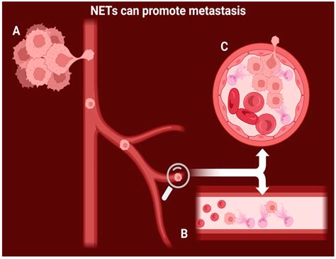 The Role of Neutrophil Extracellular Traps in the Outcome of Malignant ...