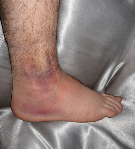 Sprained Ankle - Runner