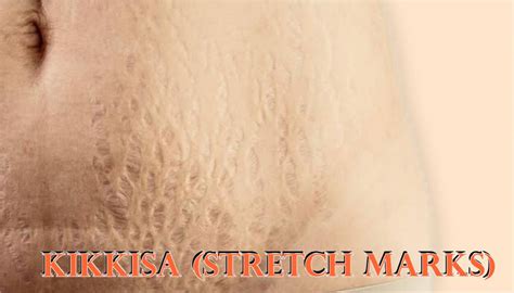 Management of Kikkisa with Lakshadi Taila w.s.r. to Striae Gravidarum ...