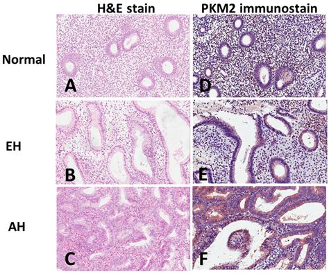 Pyruvate Kinase M2 Expression: A Potential Metabolic Biomarker to ...
