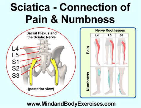 Sciatic Pain – What are Some Options? | Sciatic pain, Sciatic nerve pain, Sciatica