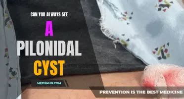 Signs And Symptoms Of A Pilonidal Cyst: How To Tell If You Have One ...