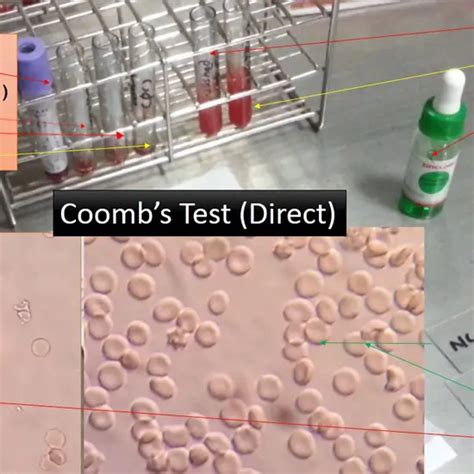 Image result for Coombs Test