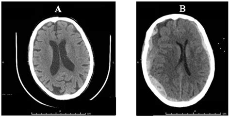 Accidental Injury or “Shaken Elderly Syndrome”? Insights from a Case Report