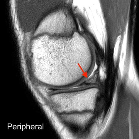 Bucket-handle Tear of the Meniscus | Radsource