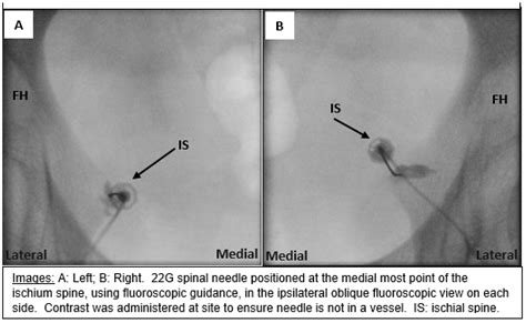 Fluoroscopy-Guided Transgluteal Pudendal Nerve Block for Pudendal Neuralgia: A Retrospective ...