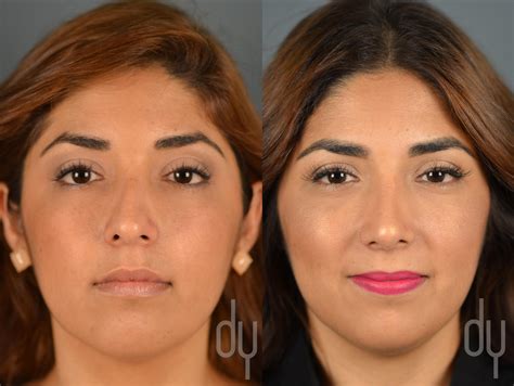 Rhinoplasty | Nose Job Recovery with Rhinoplasty Specialist Dr. Donald B. Yoo