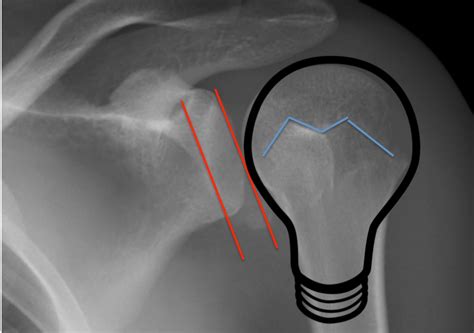 Image result for Sulcus Sign Shoulder Dislocation