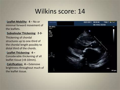Mitral valve scoring before BMV | PPTX - structure of leaflet