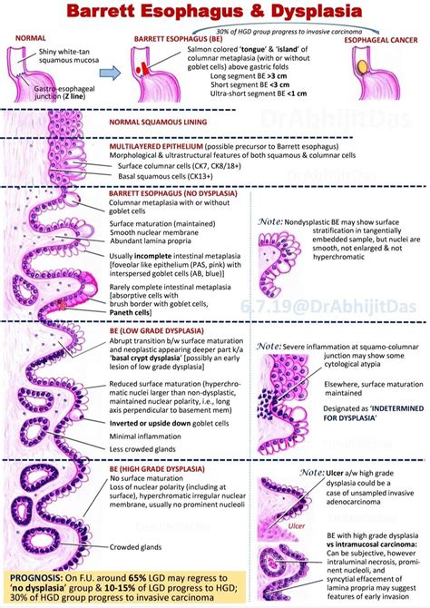 Barretts Esophagus Dysplasia