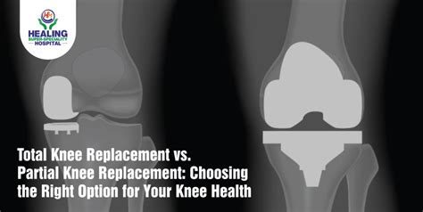 Total Knee Replacement vs. Partial Knee Replacement: Choosing the Right ...
