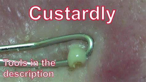 Image result for Exploding Spots