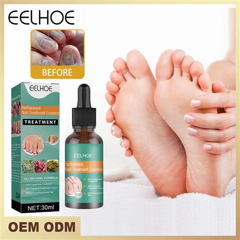 Toe Fungus Quick Treatment at Leo Bunker blog