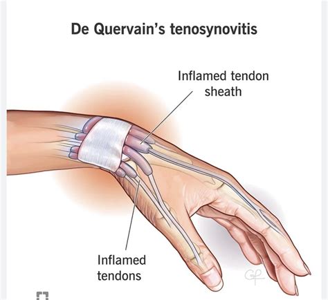 Cortisone Injection For De Quervain's Tenosynovitis at Cassandra Wild blog