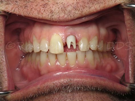 Center Front Dental Implant -Ramsey Amin DDS