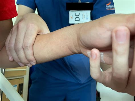 Displaced paediatric distal radius fractures with volar skin tenting ...