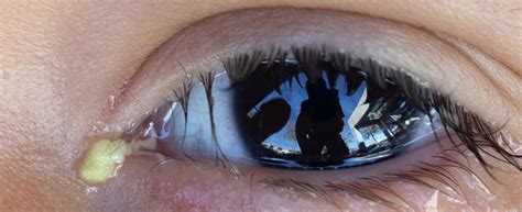 Eye Discharge: Yellow Eye Mucus Causes, Types, and Treatment