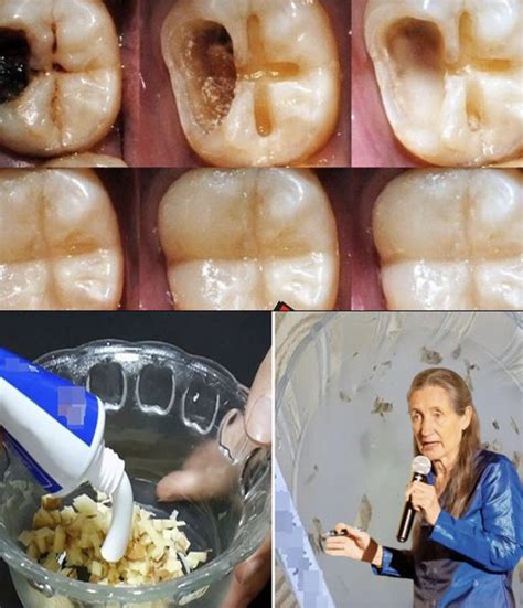 How to Naturally Repair Cavities & Strengthen Your Teeth