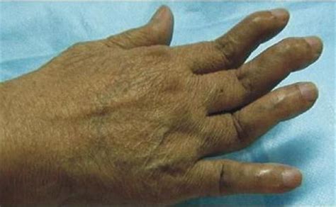 手指类风湿关节炎症状类风湿关节炎早期症状2022已更新今日热点