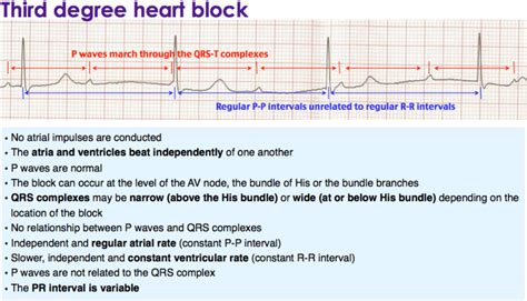 3rd degree heart block lyme disease