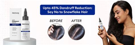 Fight Itchy Scalp with Our Ultra Concentrated Anti-dandruff Serum ...