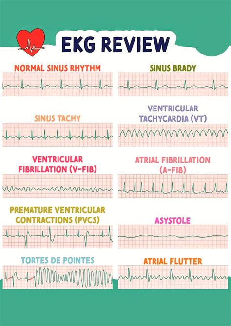 Basic ECG Rhythms 的图像结果