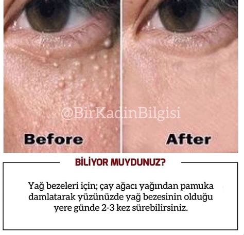Incredible i removed all milia by sugar remove white bumps under eyes milia treatment – Artofit