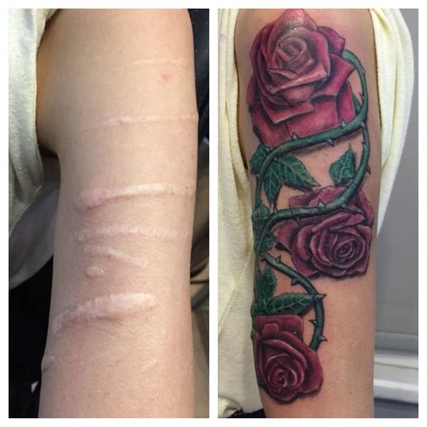 Tattoo Keloid Scarring