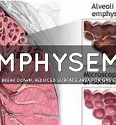 Image result for Emphysema