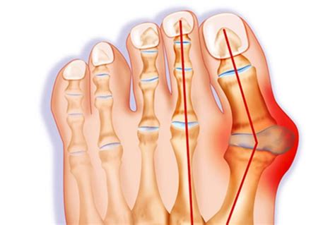 Foot and Ankle – Bunion Correction with Scarf and Akin Osteotomy | AOA ...