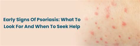 Recognizing Early Psoriasis Signs for Timely Action