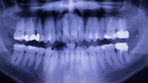 5 Types of Tooth Fillings: Which is the Best?