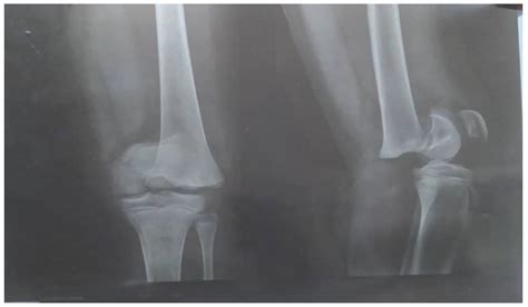 Management of Salter–Harris Type 1 Fracture Complicated with Osteomyelitis in a Sickle Cell ...
