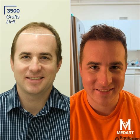 All-Inclusive Turkey Hair Transplant Package with MedArt - Medart Hair