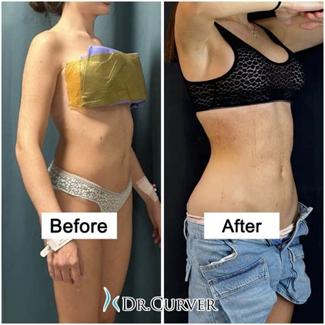 Image result for First Rib Resection Surgery