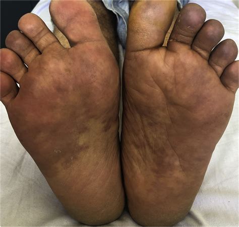 Burning red hot feet - European Journal of Internal Medicine