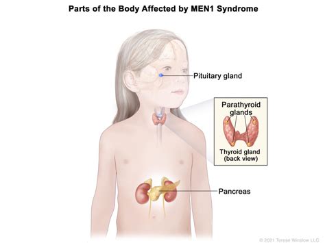 Childhood MEN1 Syndrome - NCI - Apartment Times | Noida Latest News ...