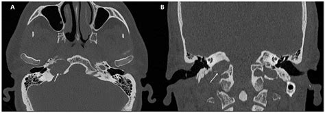 Typical and Atypical Symptoms of Petrous Apex Cholesterol Granuloma ...