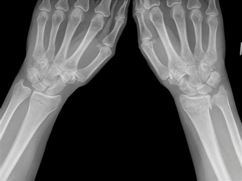 Frattura di Goyrand-Smith: Diagnosi, Trattamento e Recupero - Dott. Stefano Dipré ...