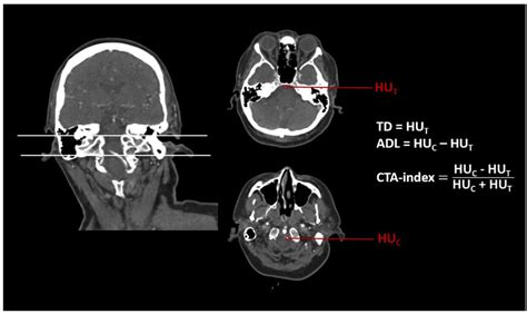 CT Marker in Emergency Imaging of Acute Basilar Artery Occlusion ...