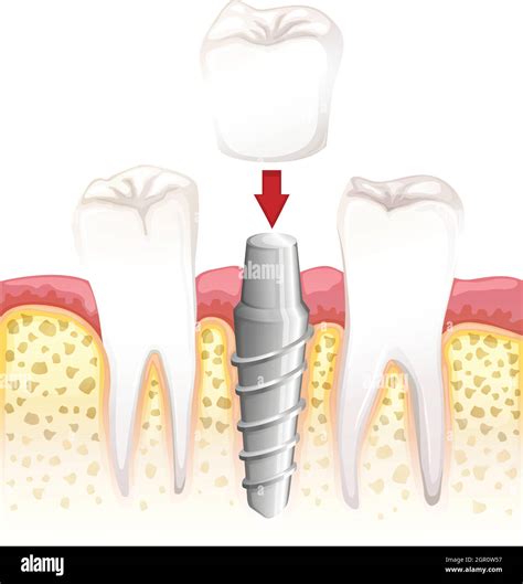 Dental crown procedure Stock Vector Image & Art - Alamy