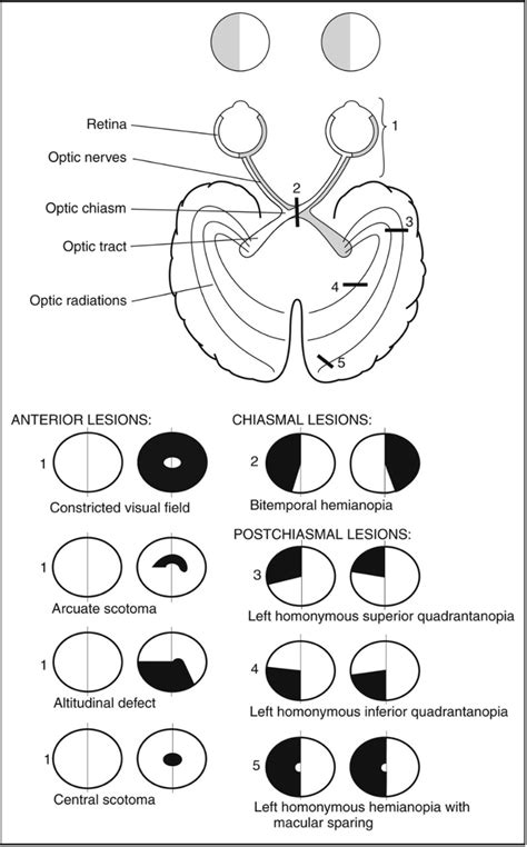 Clinical Exam: Neurological Examination and Stroke Localization – StrokeSciences