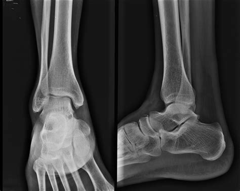 Foot Bone Fracture X Ray at Christopher Doyle blog